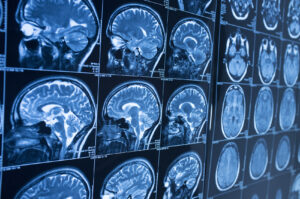 What Is a Traumatic Brain Injury?